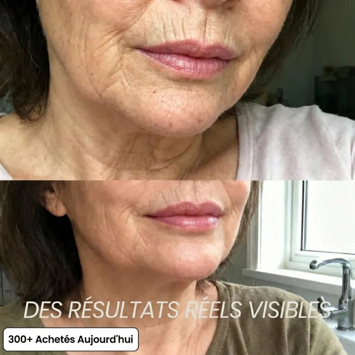 Zones creuses du visage